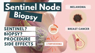 Sentinel Lymph Node Biopsy | Procedure & Side-effects | Visual Explanation