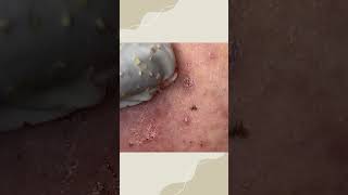 Big Cystic Acne Blackheads Extraction Blackheads & Milia, Whiteheads Removal Pimple Popping