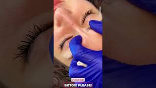 Botox Injections for Frown Lines (Glabellar) in Dubai | Reduce Wrinkles & Fine Lines