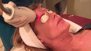 Fraxel Skin Resurfacing at Jardin Medical Spa in Philadelphia