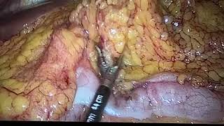 Laparoskopik qarın boşluğu törəməsinin çıxarılması/ Laparoscopic resection of the omental mass