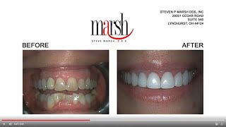 | Dr. Steve Marsh I Gum Lift Explained