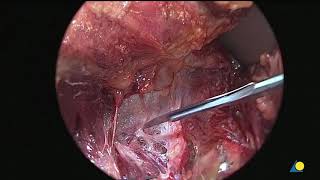 Posterior(Kocher Langenbeck Approach) of the hip and acetabulum