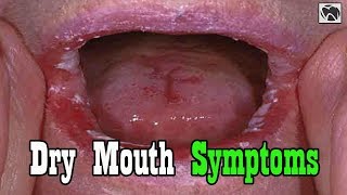 Dry Mouth Symptoms | 7 Early Symptoms of Dry Mouth Syndrome