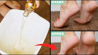 Voici une astuce au vinaigre pour adoucir les pieds secs et fissurés