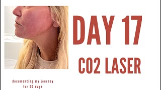 CO2 LASER FACIAL RESURFACING- 17 days after the procedure. I wish I had done this sooner!!!!!  WOW..