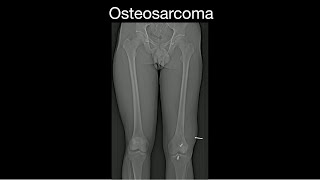 Osteosarcoma on follow up ACL imaging