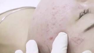 Mengenal Bekas Jerawat alias Acne Scars | Dokterkulitku