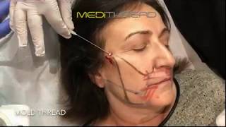 PDO-THREAD LIFT TUTORIAL BY MEDiTHREAD - FULL FACE LIFT AND CONTOUR