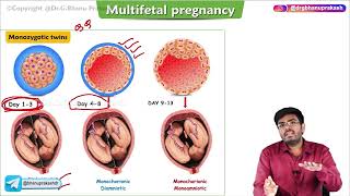 Multifetal Gestation ( Part -1) : Obstetrics and gynaecology lecture