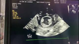 Parasternal short axis view and How to claculate Fractional shortening FS