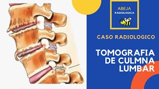 Tomografía de columna lumbar "Caso radiológico" ESPONDILOLISTESIS