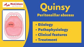 Quinsy - Peritonsillar abscess | Etiology, clinical features, treatment |Mediklaas