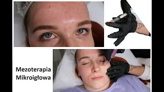 VLOG: MEZOTERAPIA MIKROIGŁOWA - czy bolało? 😩🤔🤭