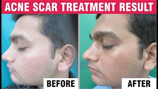 Acne Scars Treatment | Pimple Treatment | Sakhiya skin Clinic Review