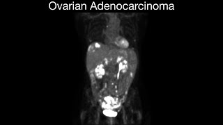 Ovarian Adenocarcinoma