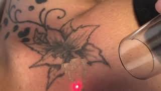 African american woman removes chest tattoo with laser