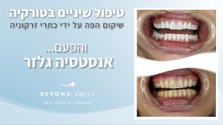 טיפולי שיניים בטורקיה עם ביונד סמייל - והפעם הוליווד סמייל מושלם של אנסטסיה