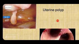 Hysteroscopy and salphingoscopy in gynecology