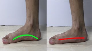 تمارين لتسطح القدم | Exercise for Flat Feet