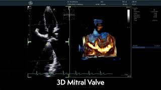 〖Echocardiography〗 The Mitral Valve in 3D - TTE 🫀