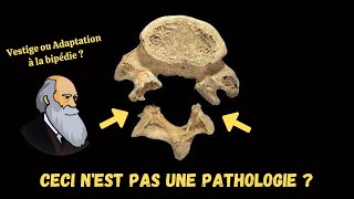 Le Spondylolisthésis* est-il une pathologie ?