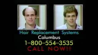 Hair Replacement Systems