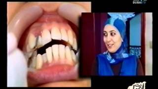 Liberty Medical Group  Dental Division  Dubai TV Anti Ajmal  Abeer  Composite Veneer مجموعة ليبرتي الطبية  قسم طب الأسنان  أنت أجمل   عبير   عدسات الأسنان اللاصقة