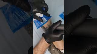 Лазерне видалення тату у Києві #tattoo