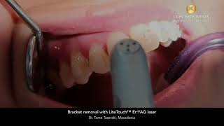 Bracket removal with LiteTouch™ Er:YAG laser