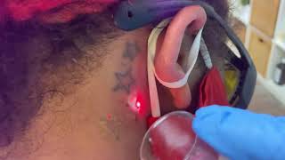 Laser tattoo removal, behind the ear tattoo, African American female