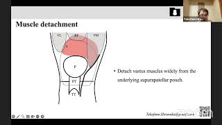 UnderVastus Approach in TKR