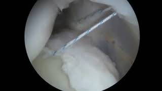 Reparación Artroscópica Labrum postero-inferior en paciente con Inestabilidad Posterior