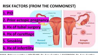 ECTOPIC PREGNANCY EXPLAINED