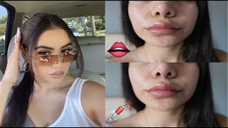 Getting Lip Injections and Botox for the first time MY EXPERIENCE | Marlenedizzle