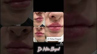 Magic of lip filler🥰🥰 #الذكاء_الاصطناعي #بوتكس #خيوط #rejuvenation #فيلر_الوجه #البلازما #botox