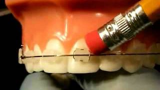 Bracesquestions.com - Braces Problems: Pain, Poking Wire, Sore Teeth, Broken Bracket