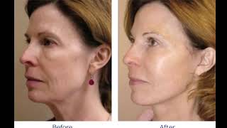 ¿Es igual enseñar Facelift o Rejuvenecimiento Facial y Barras de Access? Vitapura Chile