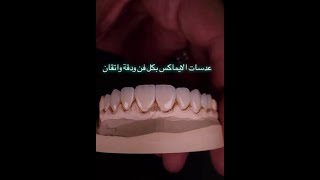 ستشعري بالدهشة عند النظر إلى النتيجة المذهلةلتجميل الأسنان بعدسات الايماكس!#ابتسامة_هوليود #تجميل