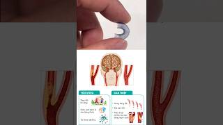 đặt Stent ở mạch máu bị hẹp hoặc tắc nghẽn