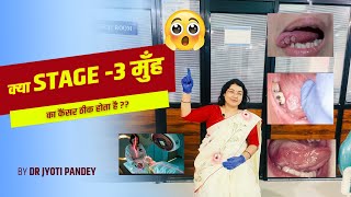 क्या stage -3 मुँह का कैंसर ठीक होता है ??