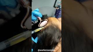 Detén la caída de cabello con plasma rico en plaquetas y factores de crecimiento #avefenixestetic