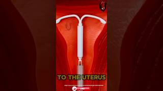 كيف يتم وضع اللولب الهرموني How  Hormonal IUD is Placed