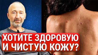 Как РЕАЛЬНО избавиться от прыщей, акне и угрей? ЭТИ малоизвестные способы помогут в 99% случаев!