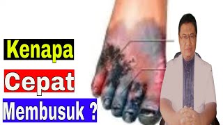 Kenapa luka diabetes membusuk dan sulit sembuh ?