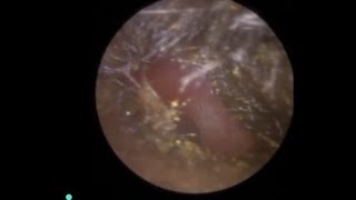 Ear PIMPLE discovered after Ear Wax Removal