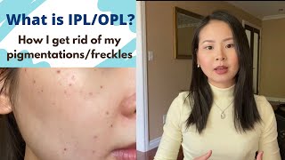 How I get rid of my Pigmentations/Freckles (IPL/OPL Treatment)