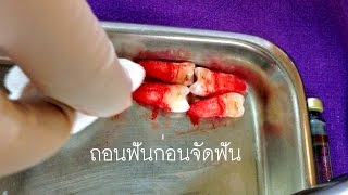 จัดฟัน - ถอนฟันก่อนจัดฟัน 4 ซี่