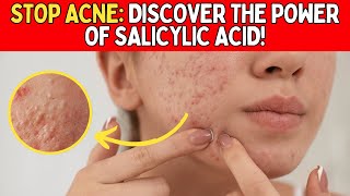 🔴Salicylic Acid🔴: The Secret to Blemish-Free, Radiant Skin ✨ #salicylicacid #acnefree