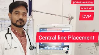 Central line Placement || Central Venous Catheterization || CVP ||Subclavian Venous Catheterization